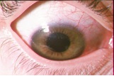 Do you have dry eyes?