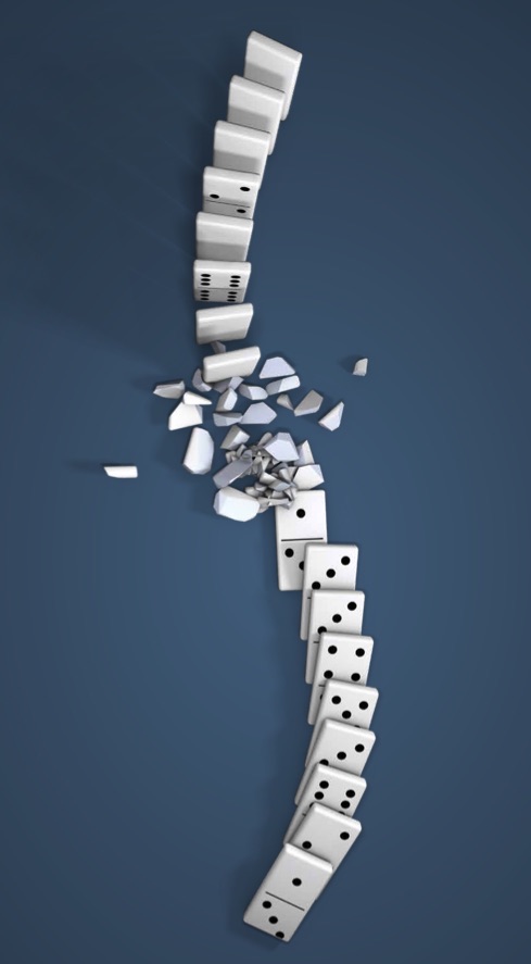Don’t miss the signs of a breaking spine